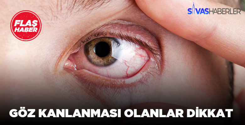 Gözünüzde kanlanma varsa dikkat !