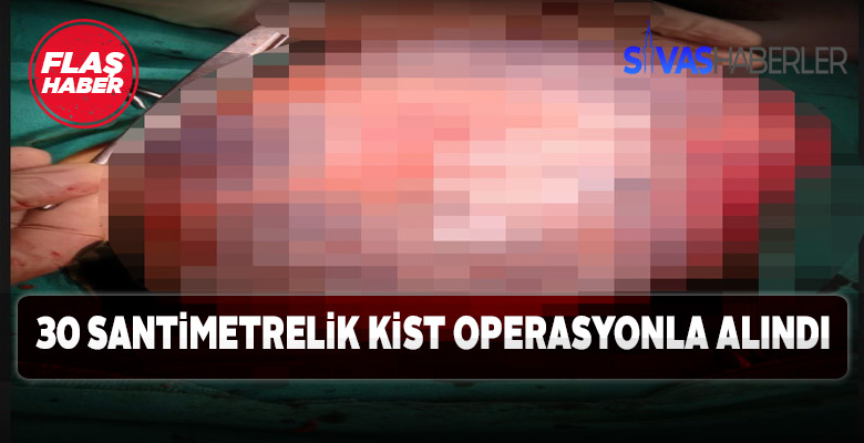 Karnındaki 30 santimetrelik Kist çıkarıldı