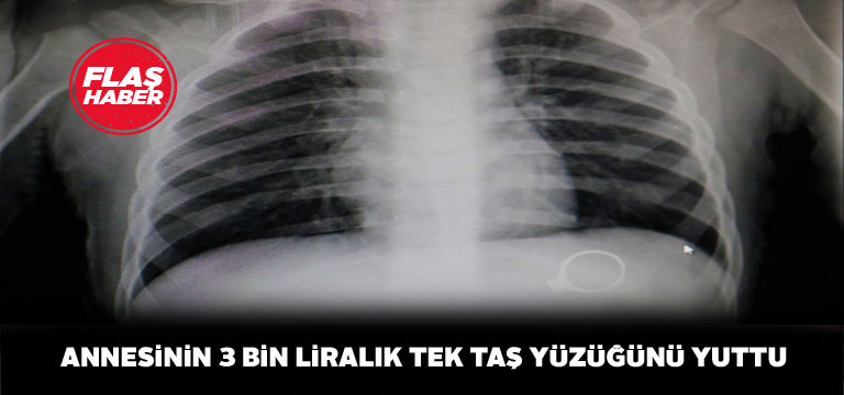 1,5 yaşındaki bebek yuttuğu tek taş yüzüğü 6 günde çıkardı