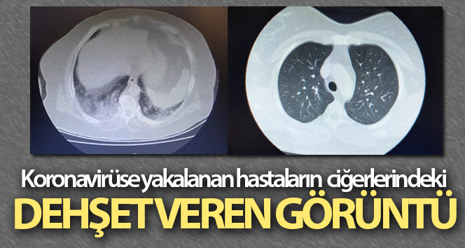 Koronavirüslü hastaların akciğerlerindeki korkunç görüntü