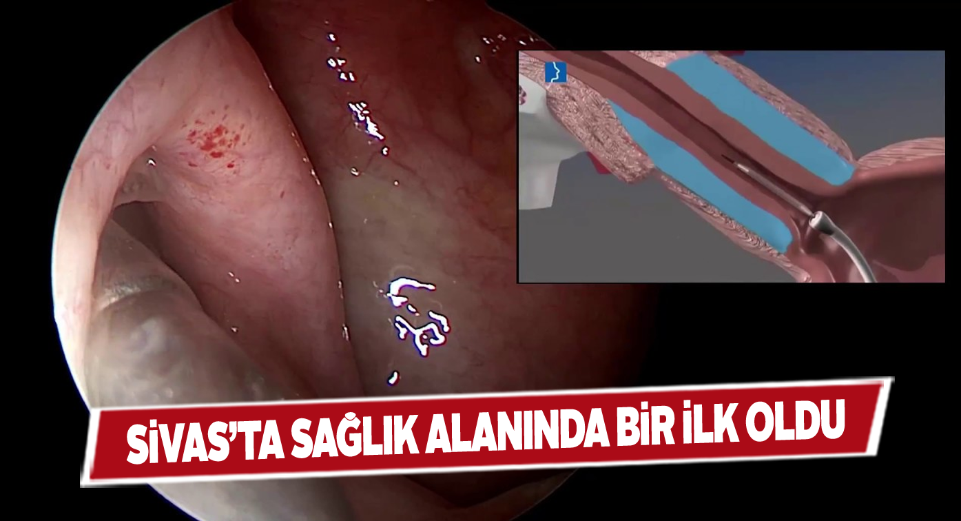 Bu operasyon artık Sivas’ta da yapılıyor!