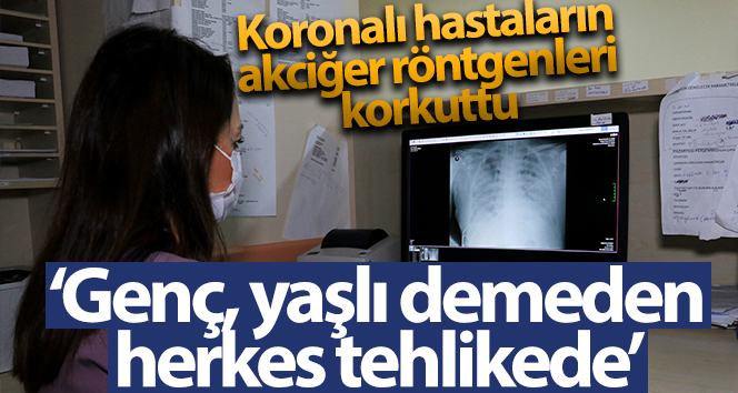 Korona korkusu olan hastaların akciğer röntgeni