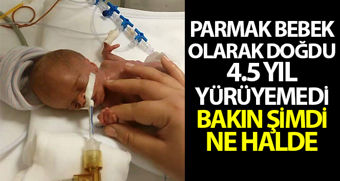 Oyuncak bebek olarak doğdu, 4,5 yıl yürüyemedi, bak şimdi nasıl