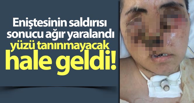 Eniştesinin saldırısı sonucu ağır yaralandı, yüzü tanınmayacak hale geldi