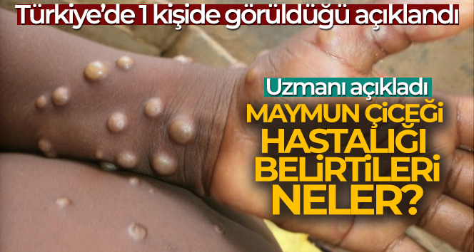 Maymun Çiçeği nedir? Maymun Çiceği belirtileri neler!