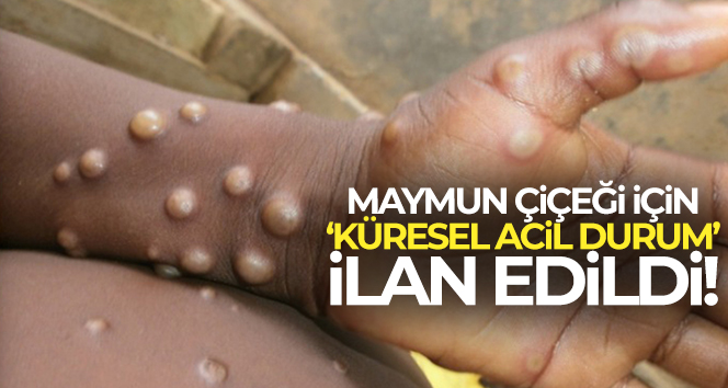 Maymun çiçeği için küresel acil durum ilân edildi!