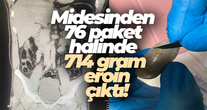 Batman’da bir kişinin midesinden 714 gram eroin ele geçirildi