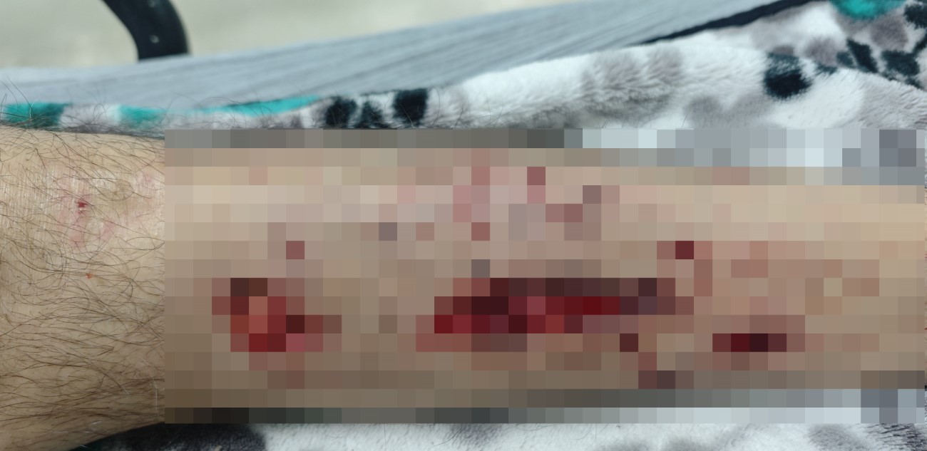 Alzheimer Hastası Yaşlı Adam Sokak Köpeklerinin Saldırısına Uğradı