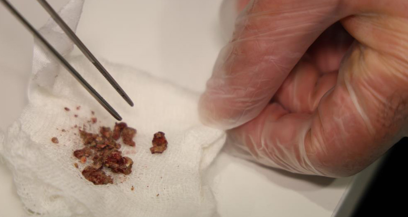 Elazığ’da Estetik Ameliyat Sırasında Burundan Taş Çıkartıldı