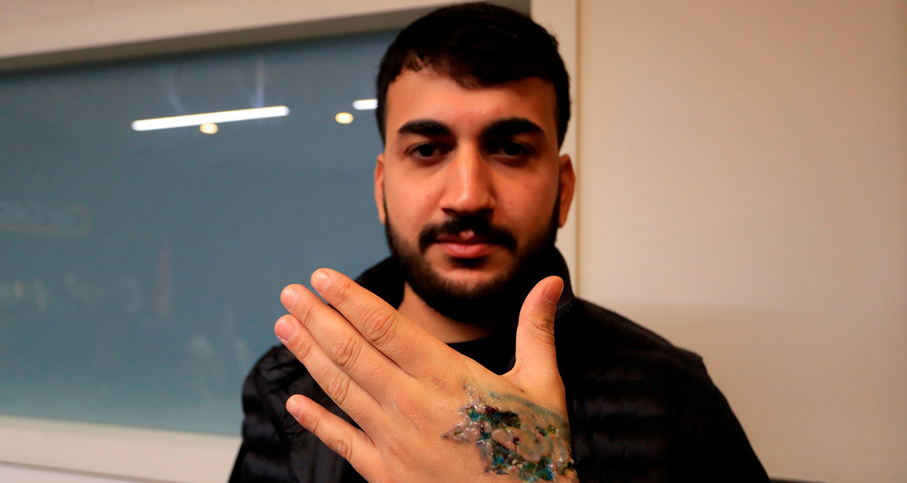 Dövme Silme İşlemi Felaketle Sonuçlandı: Ciddi Yanıklar ve Doku Kaybı