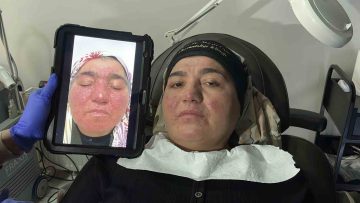 Sivas’ta Bir Umut Işığı: Gül Hastalığı Tedavisinin Başarı Hikayesi