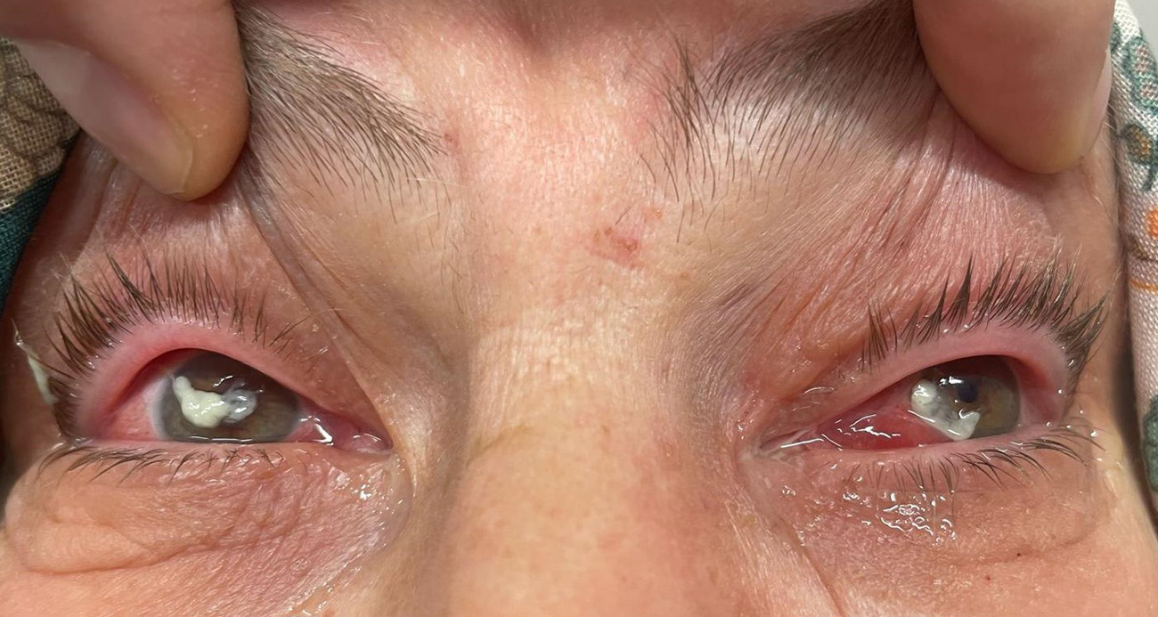 ’Kırlangıç otu kullanımı’na dikkat, uzmanlar uyarıyor: “Gözlerine suyunu damlattı, göremez hale geldi”