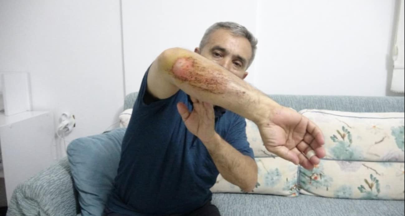 Otizmli oğluyla doğa gezisi sırasında sahipli köpeklerin saldırısına uğradı