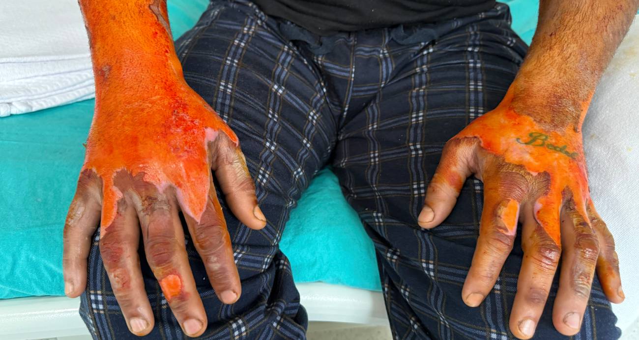 Akü patlaması, vücudunun yüzde 25’i yandı: “Bomba gibi patlamalar oldu, kendimi zor kurtardım”